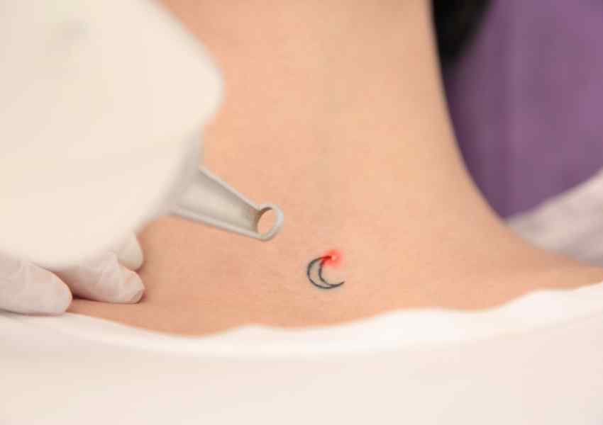 Popular Destinations for Tattoo Removal